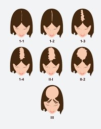 Perte de cheveux chez la femme