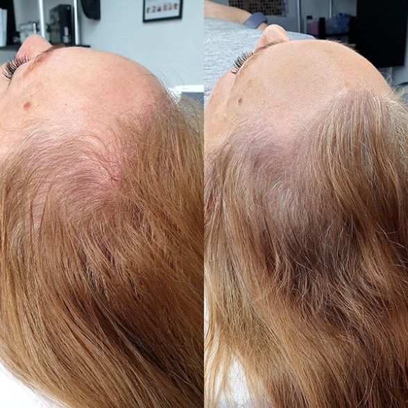 tricopigmentation sur femme blonde